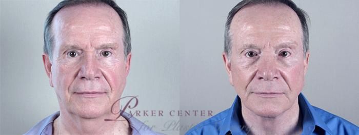 Facelift Case 15 Before & After View #1 | Paramus, NJ | Parker Center for Plastic Surgery