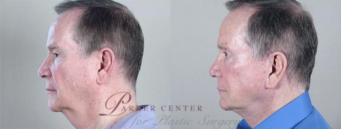 Facelift Case 15 Before & After View #2 | Paramus, NJ | Parker Center for Plastic Surgery