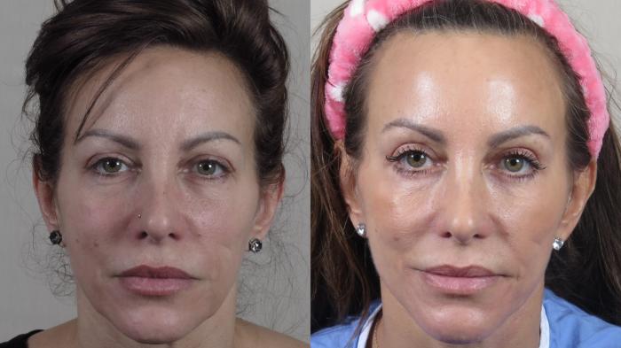 Facelift Case 1511 Before & After Front | Paramus, New Jersey | Parker Center for Plastic Surgery