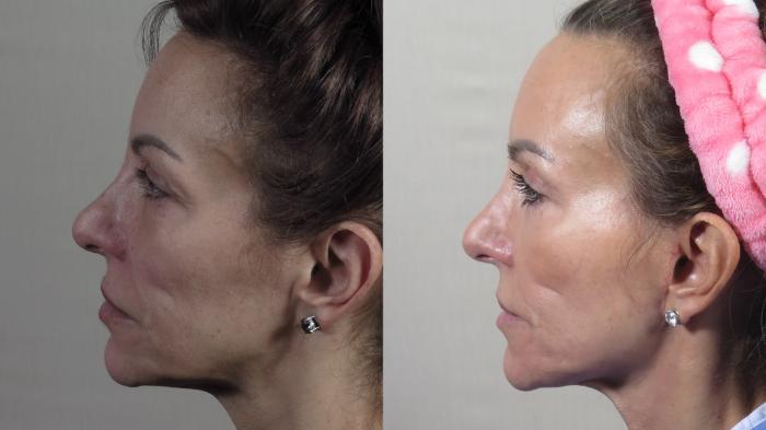 Facelift Case 1511 Before & After Left Side | Paramus, New Jersey | Parker Center for Plastic Surgery