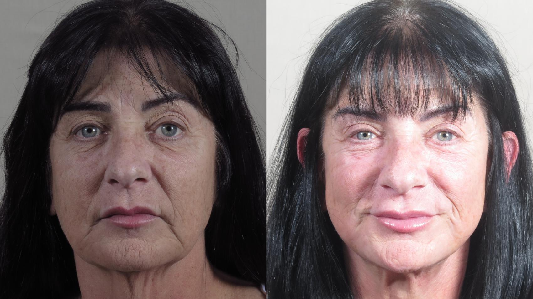 Facelift Case 1531 Before & After Front | Paramus, New Jersey | Parker Center for Plastic Surgery