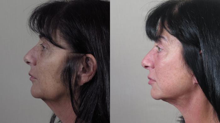 Facelift Case 1531 Before & After Left Side | Paramus, New Jersey | Parker Center for Plastic Surgery