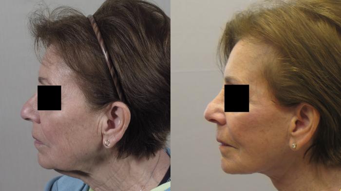 Facelift Case 1580 Before & After Left Side | Paramus, New Jersey | Parker Center for Plastic Surgery
