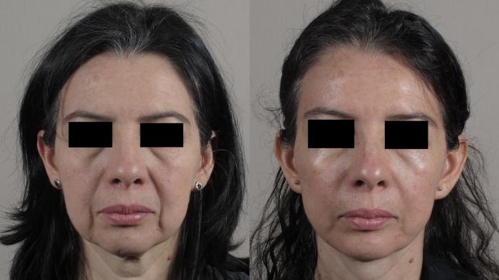 Facelift Case 1582 Before & After front 1 | Paramus, New Jersey | Parker Center for Plastic Surgery