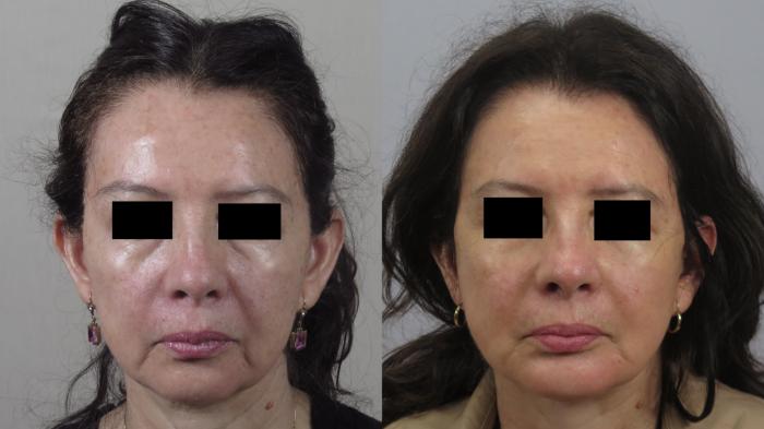 Facelift Case 1582 Before & After Front | Paramus, New Jersey | Parker Center for Plastic Surgery