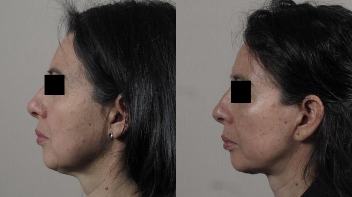 Facelift Case 1582 Before & After left side 1 | Paramus, New Jersey | Parker Center for Plastic Surgery