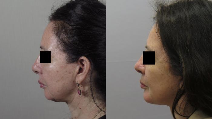 Facelift Case 1582 Before & After Left Side | Paramus, New Jersey | Parker Center for Plastic Surgery