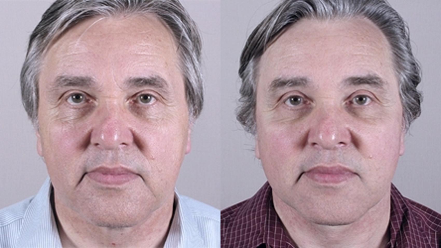 Facelift Case 16 Before & After View #1 | Paramus, New Jersey | Parker Center for Plastic Surgery