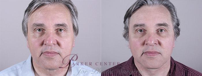 Facelift Case 16 Before & After View #1 | Paramus, NJ | Parker Center for Plastic Surgery