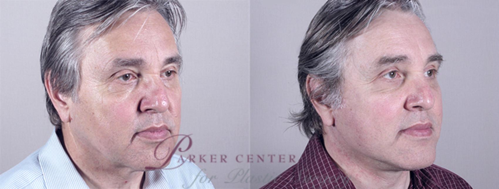 Facelift Case 16 Before & After View #2 | Paramus, NJ | Parker Center for Plastic Surgery