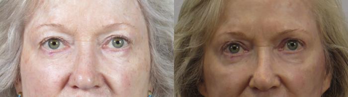 Facelift Case 1620 Before & After front 1 | Paramus, New Jersey | Parker Center for Plastic Surgery