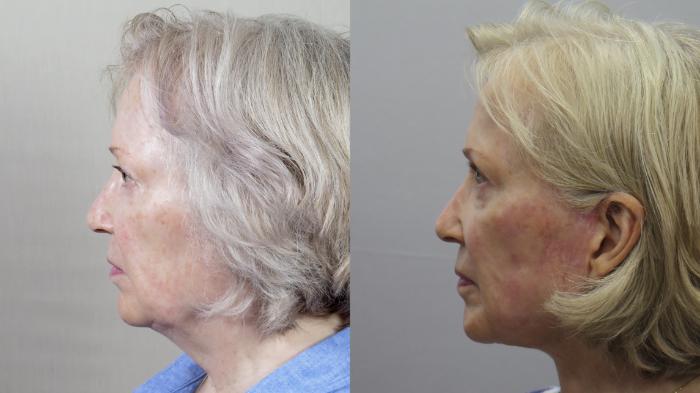 Facelift Case 1620 Before & After Left Side | Paramus, New Jersey | Parker Center for Plastic Surgery