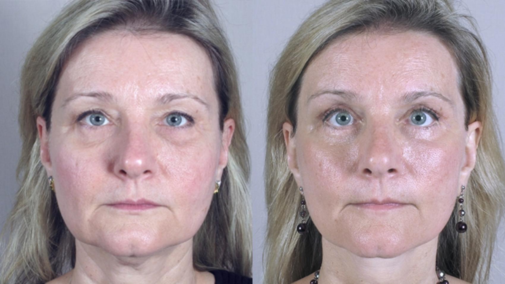 Facelift Case 17 Before & After View #1 | Paramus, NJ | Parker Center for Plastic Surgery