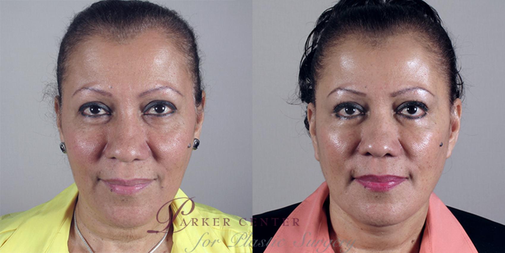 Facelift Case 19 Before & After View #1 | Paramus, NJ | Parker Center for Plastic Surgery
