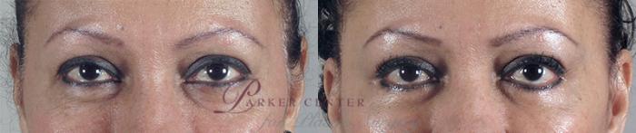 Facelift Case 19 Before & After View #3 | Paramus, NJ | Parker Center for Plastic Surgery