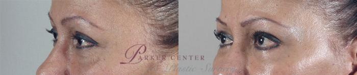 Facelift Case 19 Before & After View #4 | Paramus, NJ | Parker Center for Plastic Surgery
