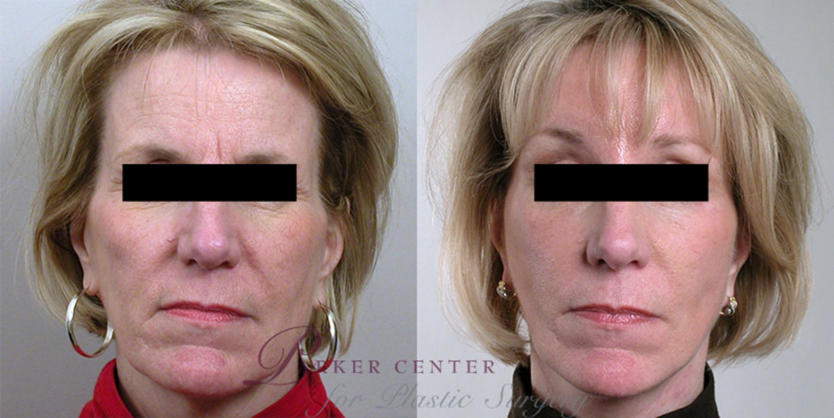 Facelift Case 20 Before & After View #1 | Paramus, NJ | Parker Center for Plastic Surgery