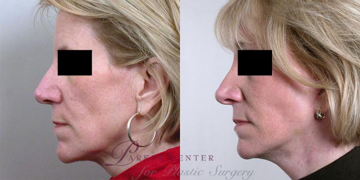 Facelift Case 20 Before & After View #2 | Paramus, NJ | Parker Center for Plastic Surgery