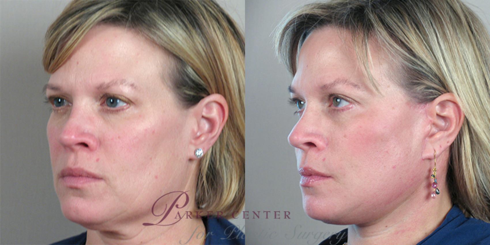 Facelift Case 21 Before & After View #2 | Paramus, NJ | Parker Center for Plastic Surgery