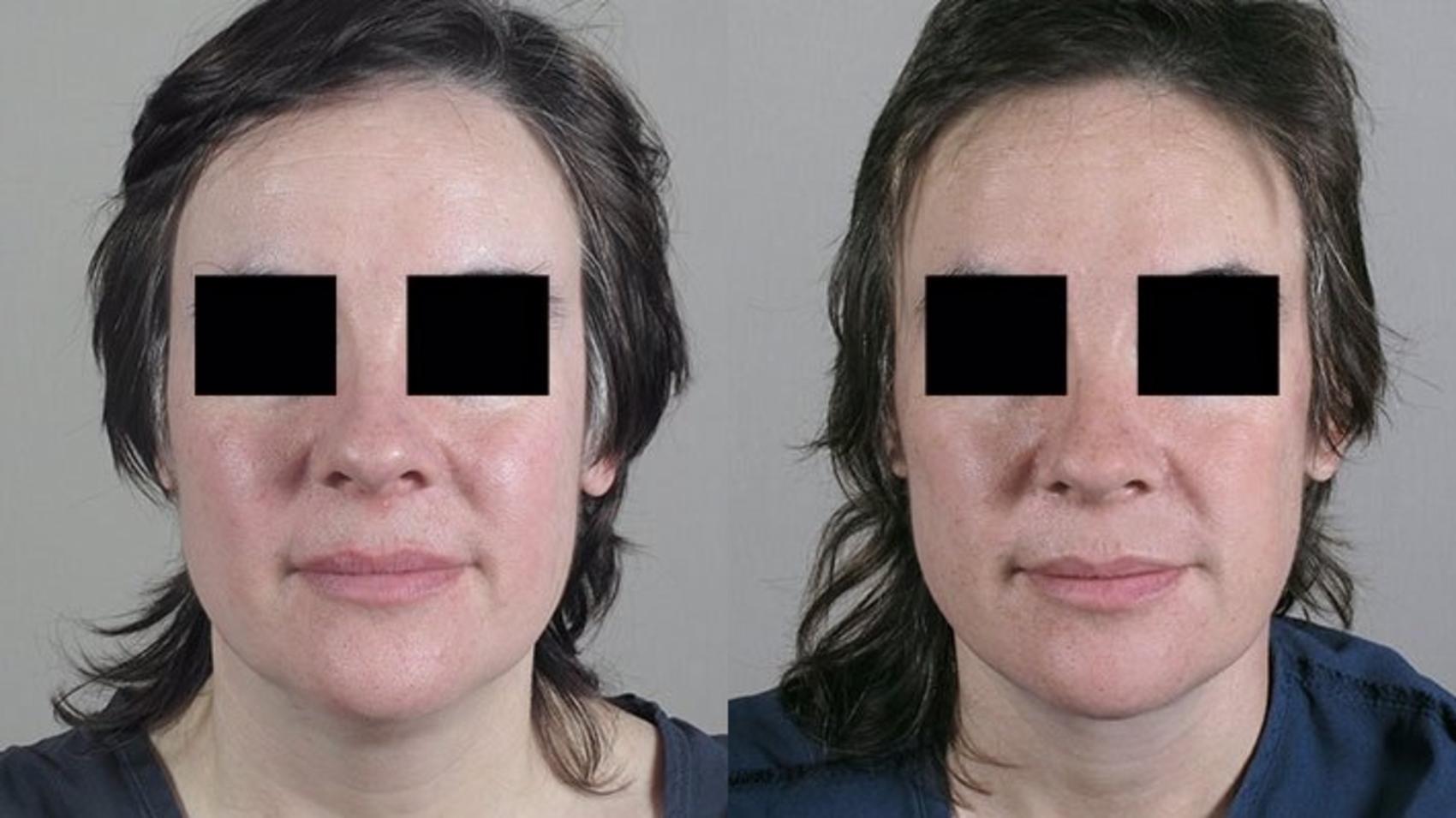 Facelift Case 22 Before & After View #1 | Paramus, New Jersey | Parker Center for Plastic Surgery