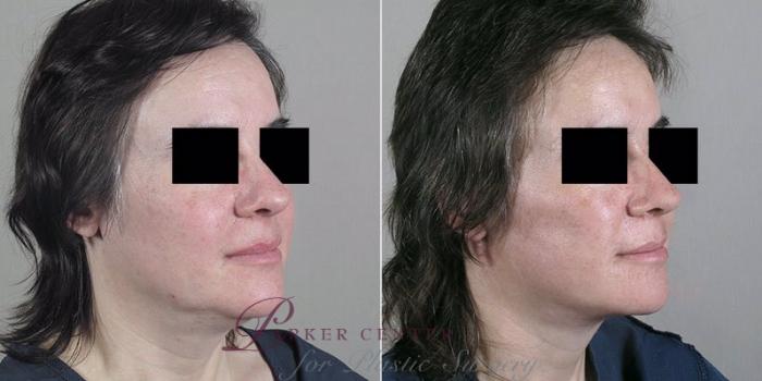 Facelift Case 22 Before & After View #2 | Paramus, NJ | Parker Center for Plastic Surgery