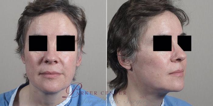 Facelift Case 22 Before & After View #3 | Paramus, NJ | Parker Center for Plastic Surgery