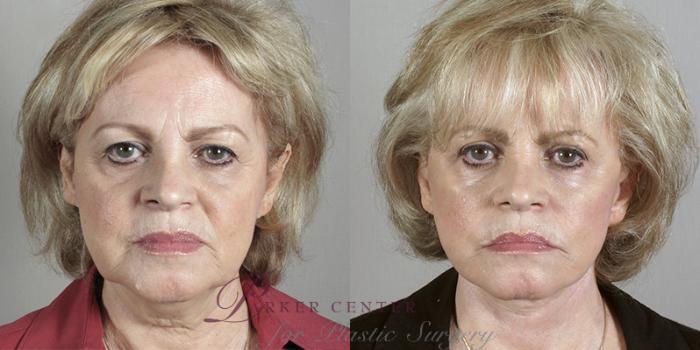 Facelift Case 23 Before & After View #1 | Paramus, NJ | Parker Center for Plastic Surgery