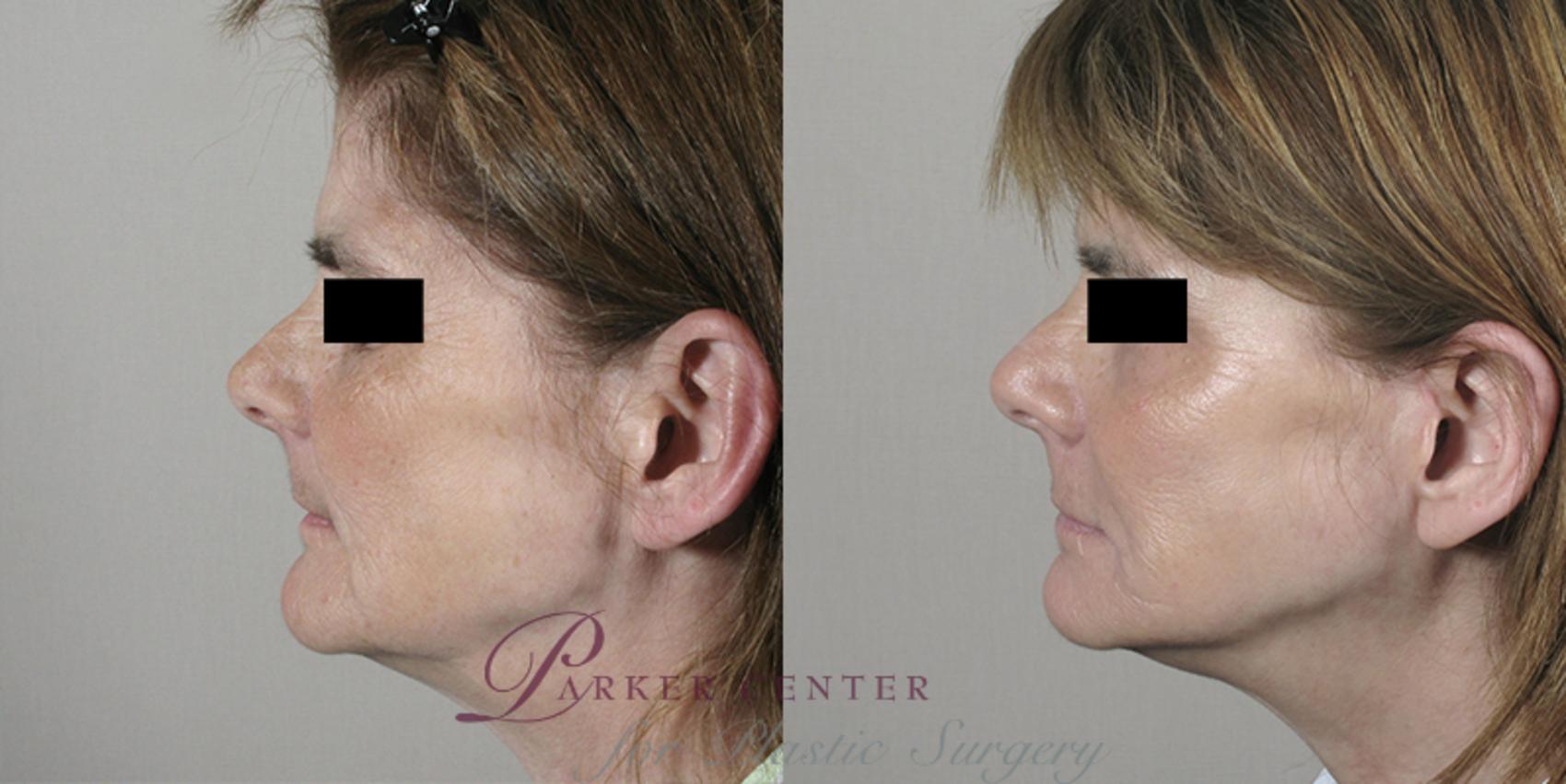 Nonsurgical Face Procedures Case 24 Before & After View #2 | Paramus, NJ | Parker Center for Plastic Surgery