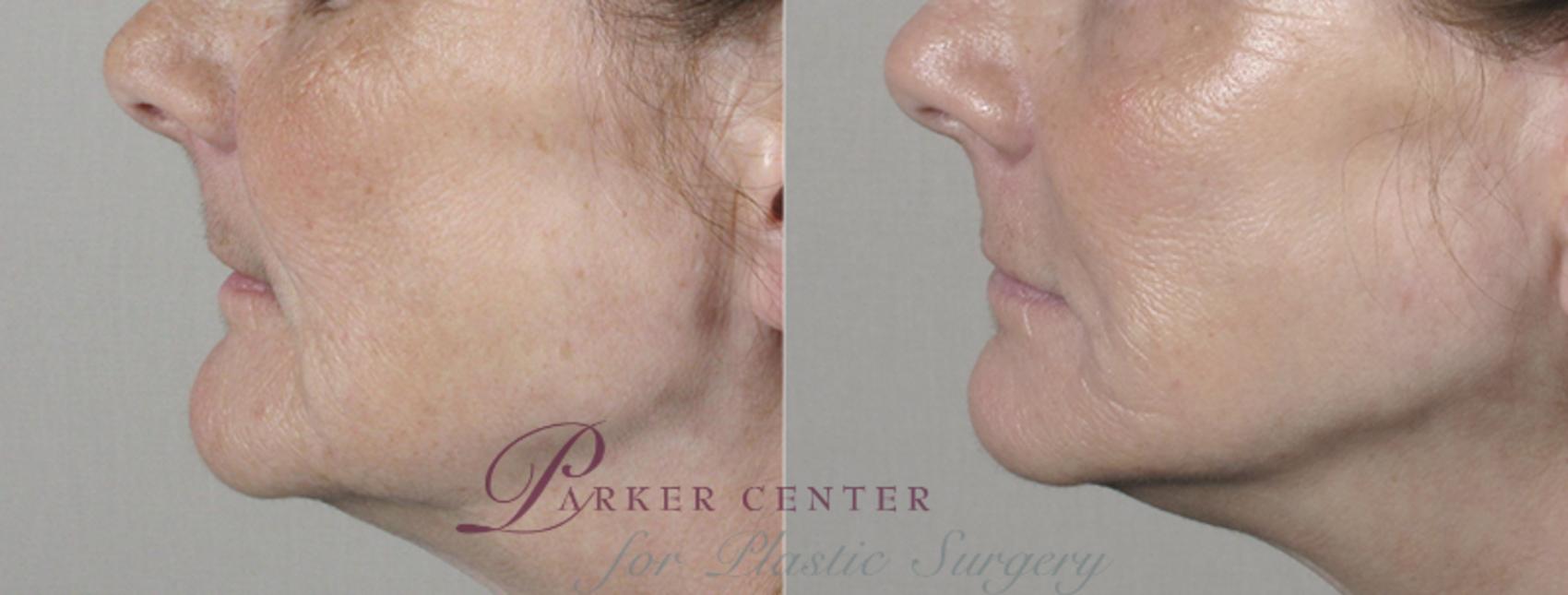 Nonsurgical Face Procedures Case 24 Before & After View #4 | Paramus, NJ | Parker Center for Plastic Surgery