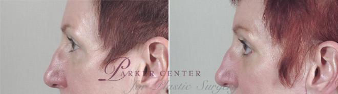 Neck Contouring Case 26 Before & After View #4 | Paramus, NJ | Parker Center for Plastic Surgery