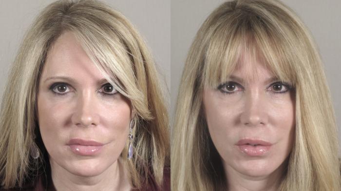 Facelift Case 27 Before & After Front | Paramus, New Jersey | Parker Center for Plastic Surgery