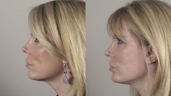 Facelift Case 27 Before & After left | Paramus, New Jersey | Parker Center for Plastic Surgery