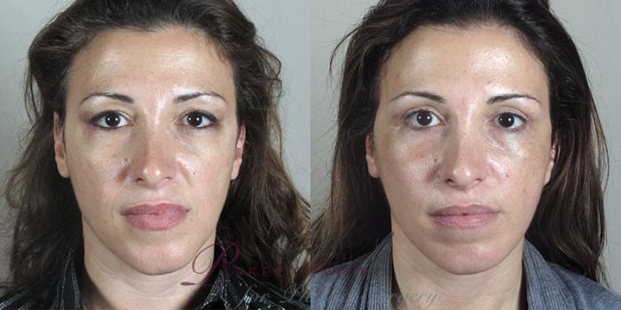 Facelift Case 28 Before & After View #1 | Paramus, NJ | Parker Center for Plastic Surgery