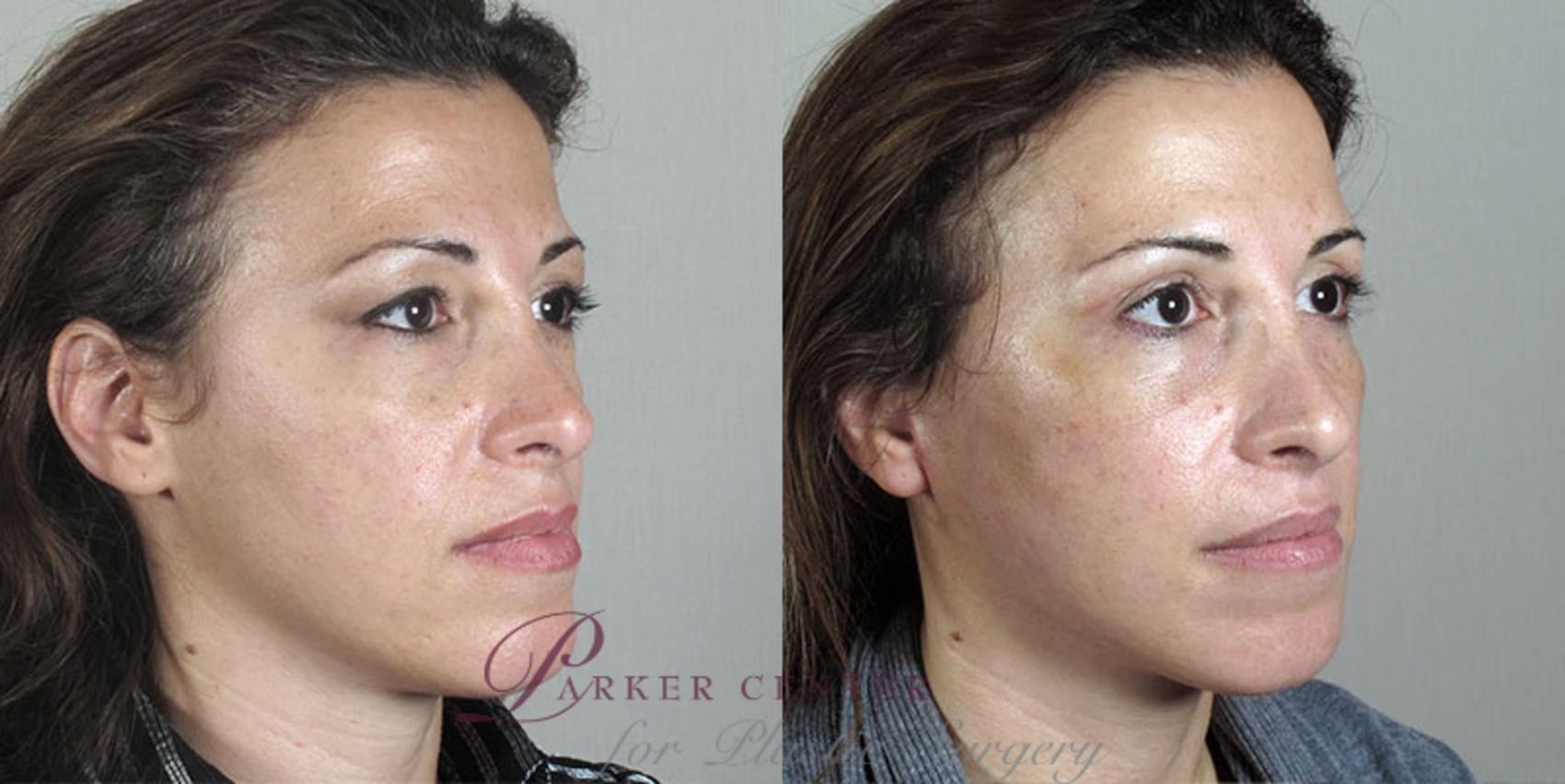 Nonsurgical Face Procedures Case 28 Before & After View #2 | Paramus, NJ | Parker Center for Plastic Surgery