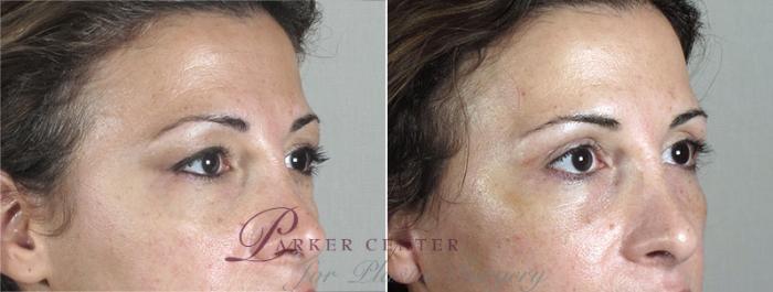 Facelift Case 28 Before & After View #4 | Paramus, NJ | Parker Center for Plastic Surgery