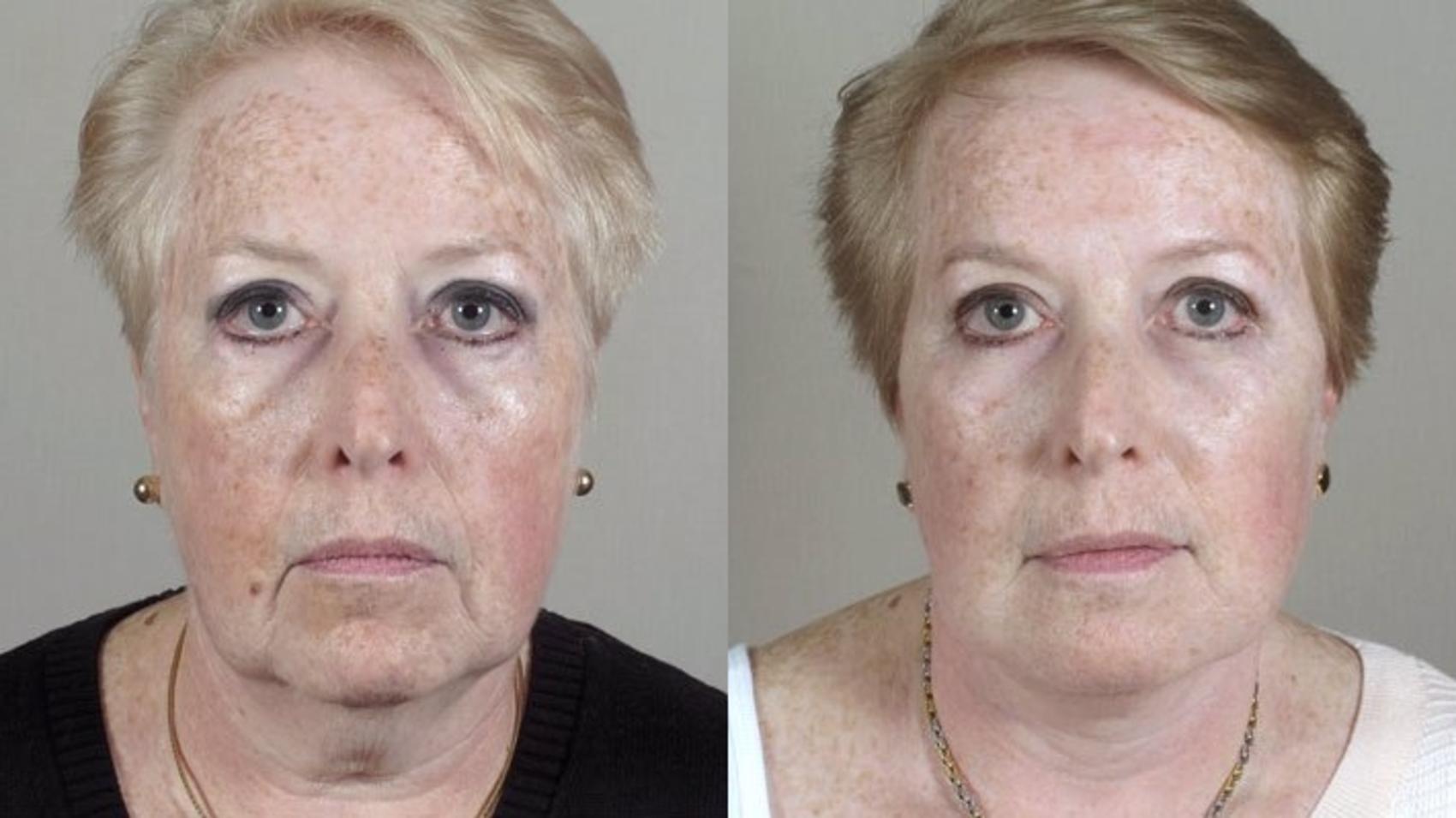 Fat Injection Case 30 Before & After View #1 | Paramus, NJ | Parker Center for Plastic Surgery