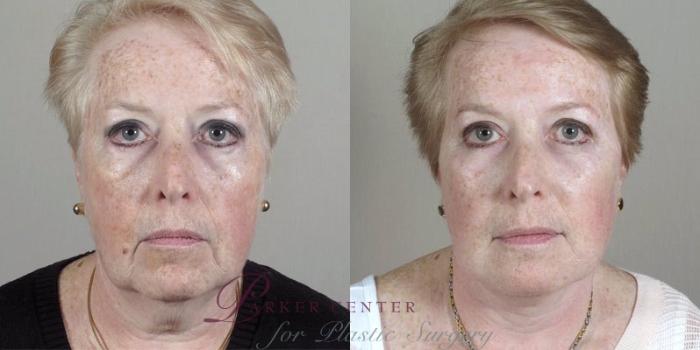 Facelift Case 30 Before & After View #1 | Paramus, NJ | Parker Center for Plastic Surgery