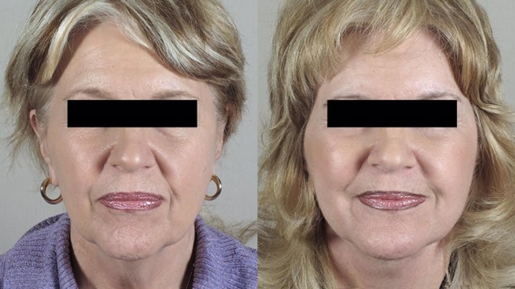 Facelift Case 31 Before & After View #1 | Paramus, NJ | Parker Center for Plastic Surgery