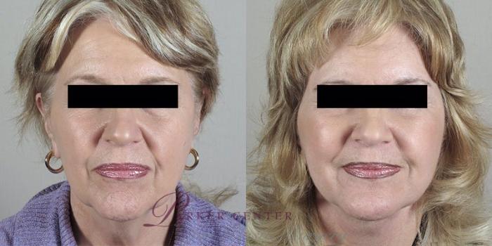 Facelift Case 31 Before & After View #1 | Paramus, NJ | Parker Center for Plastic Surgery