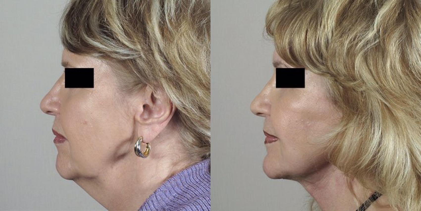 Facelift Case 31 Before & After View #2 | Paramus, New Jersey | Parker Center for Plastic Surgery