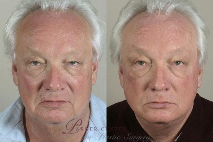 Facelift Case 32 Before & After View #1 | Paramus, NJ | Parker Center for Plastic Surgery