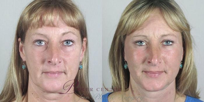 Facelift Case 33 Before & After View #1 | Paramus, NJ | Parker Center for Plastic Surgery