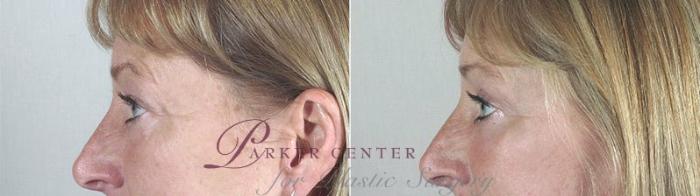 Facelift Case 33 Before & After View #6 | Paramus, NJ | Parker Center for Plastic Surgery