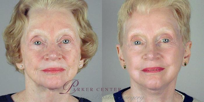 Facelift Case 35 Before & After View #1 | Paramus, NJ | Parker Center for Plastic Surgery