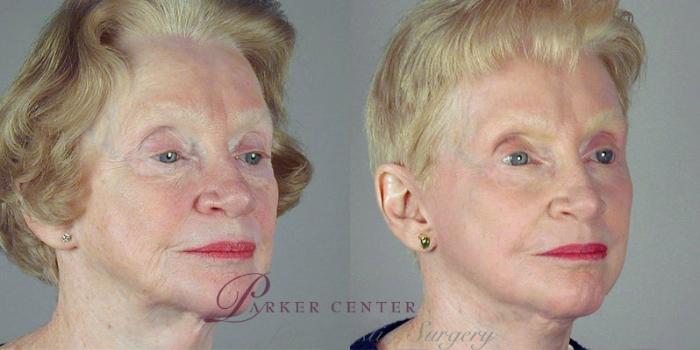 Facelift Case 35 Before & After View #2 | Paramus, NJ | Parker Center for Plastic Surgery