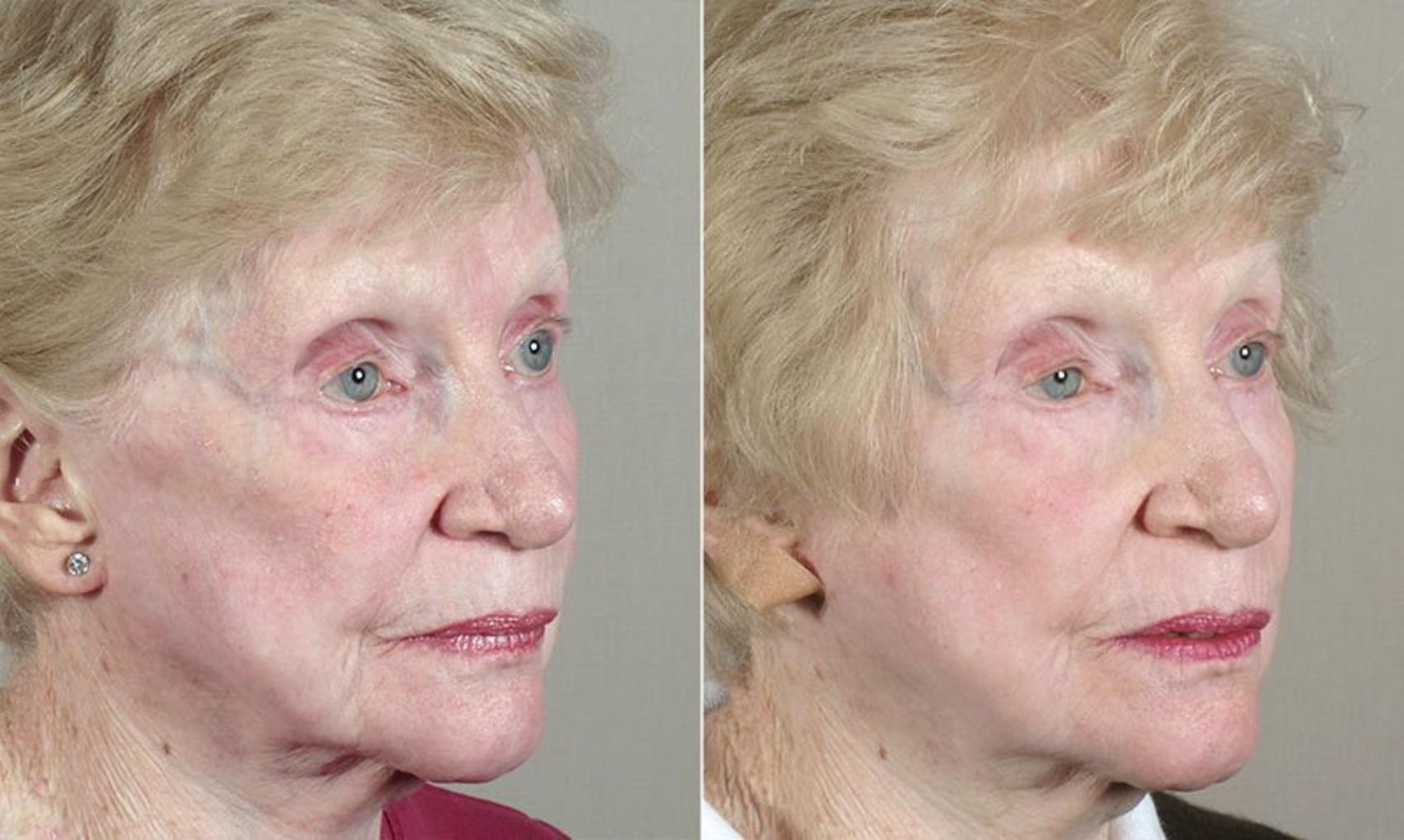 Facelift Before And After Pictures Case Paramus NJ Parker Center For Plastic Surgery