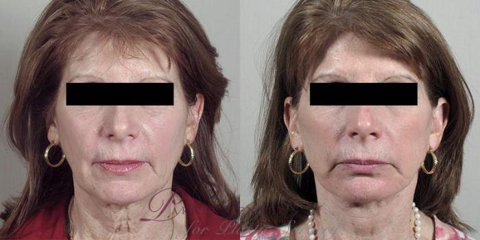 Facelift Case 37 Before & After View #1 | Paramus, NJ | Parker Center for Plastic Surgery