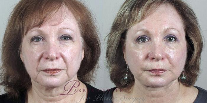 Facelift Case 39 Before & After View #1 | Paramus, NJ | Parker Center for Plastic Surgery