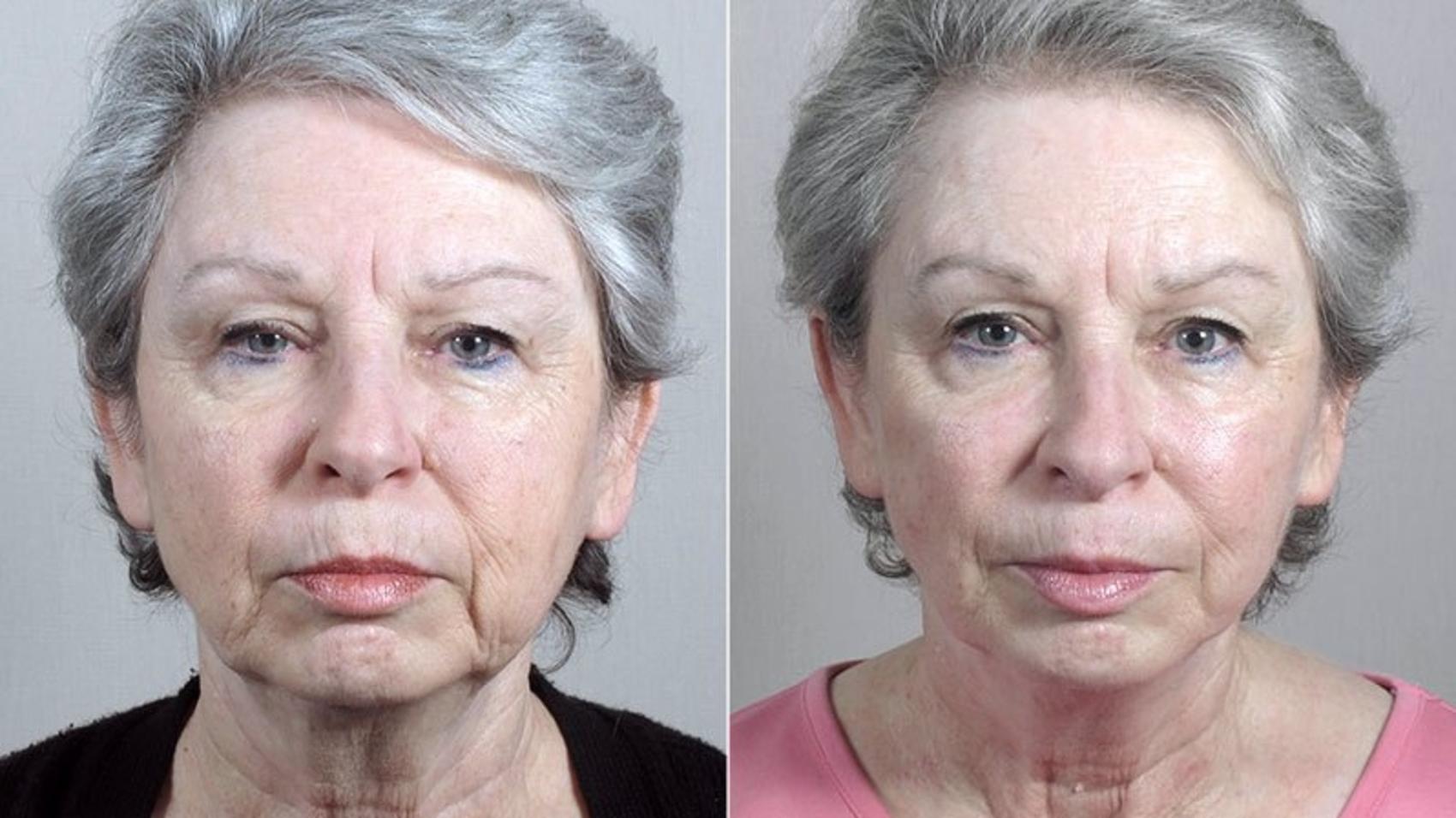 Facelift Case 40 Before & After View #1 | Paramus, NJ | Parker Center for Plastic Surgery