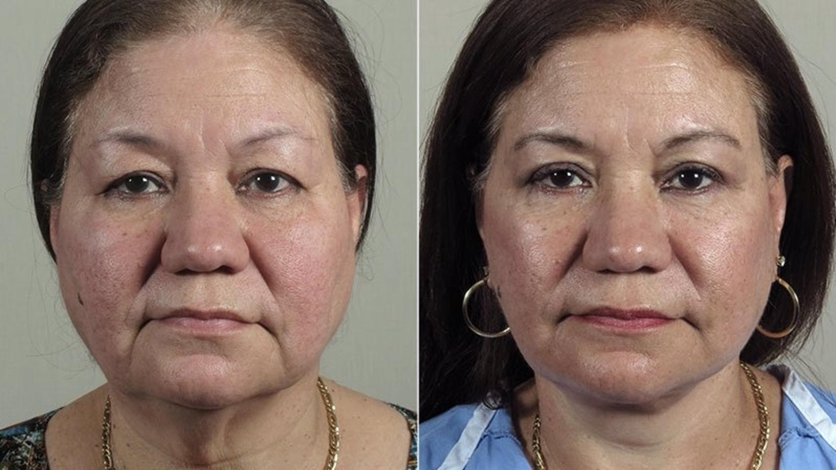 Facelift Case 41 Before & After View #1 | Paramus, New Jersey | Parker Center for Plastic Surgery